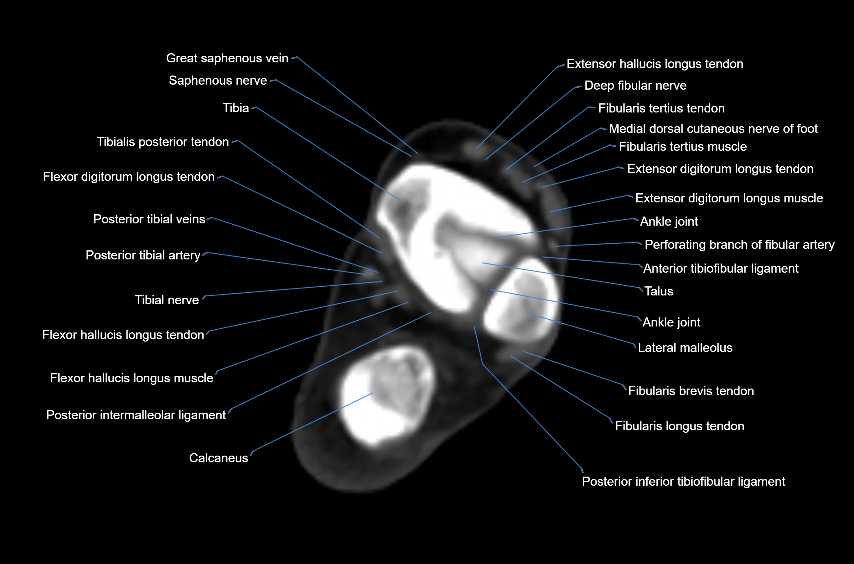 CT Ankle axial cross sectional anatomy labelled image -00029.webp